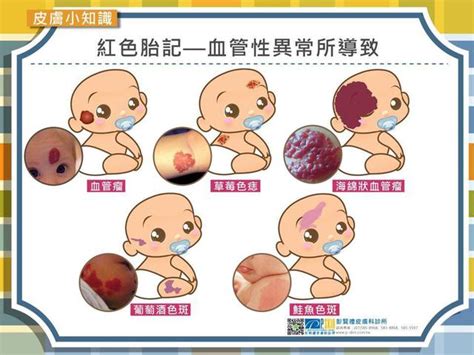 胎記位置意義